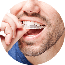 man applying his teeth aligners