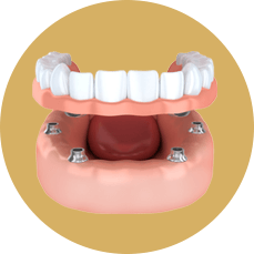 diagram of implant-supported dentures