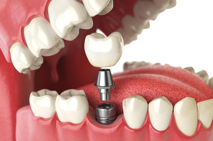 Side view computer generated image of dental implant procedure