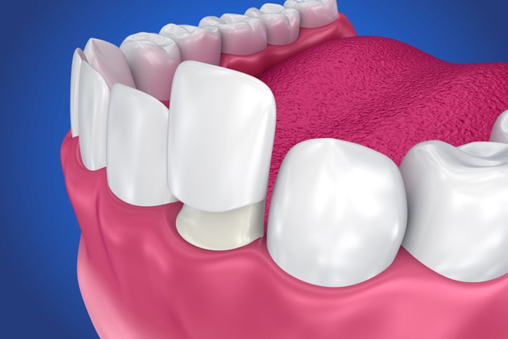 An illustration of a veneer going onto a prepared tooth