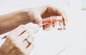 hands holding and demonstrating a model of dental implants