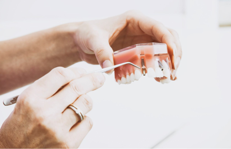 hands holding and demonstrating a model of dental implants